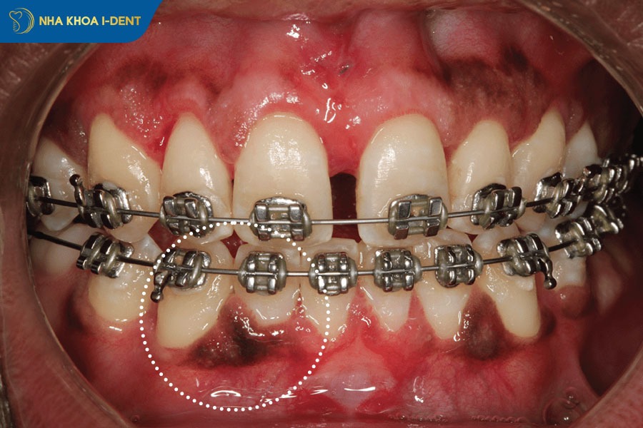 tác hại của niềng răng