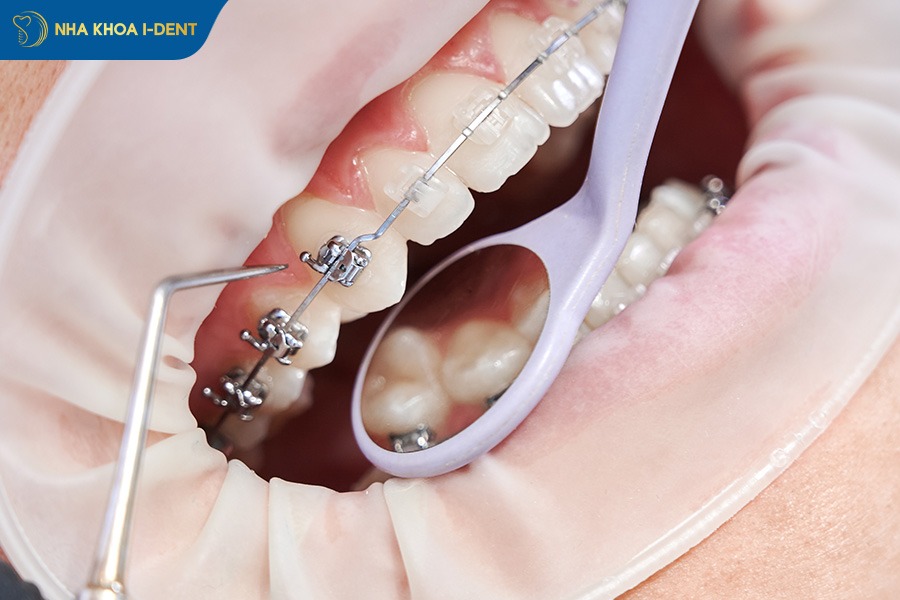 tại sao thái dương bị hóp khi niềng