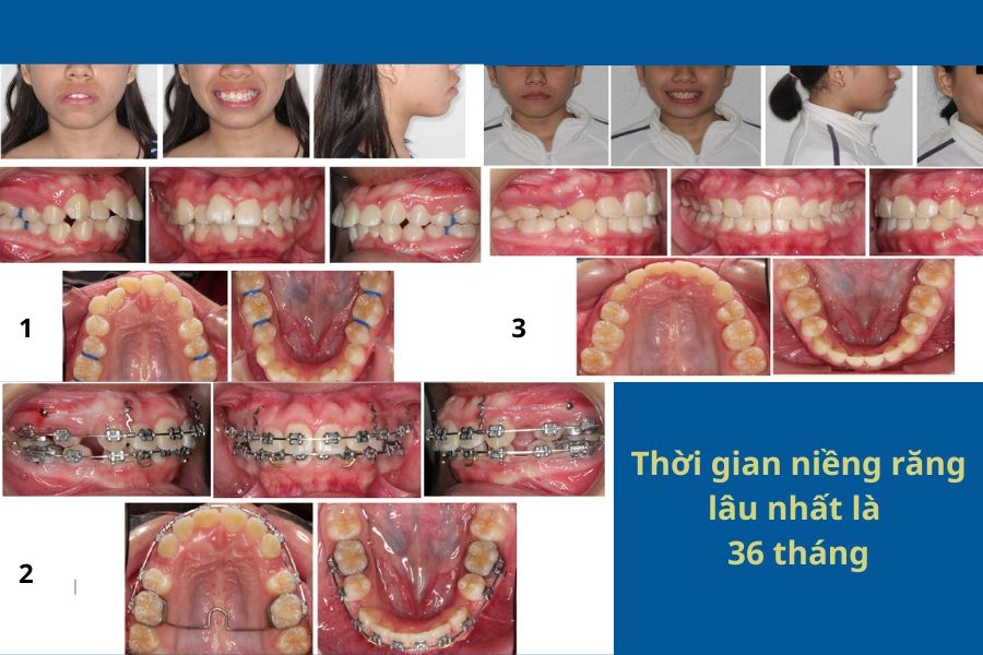 Thời gian niềng răng lâu nhất