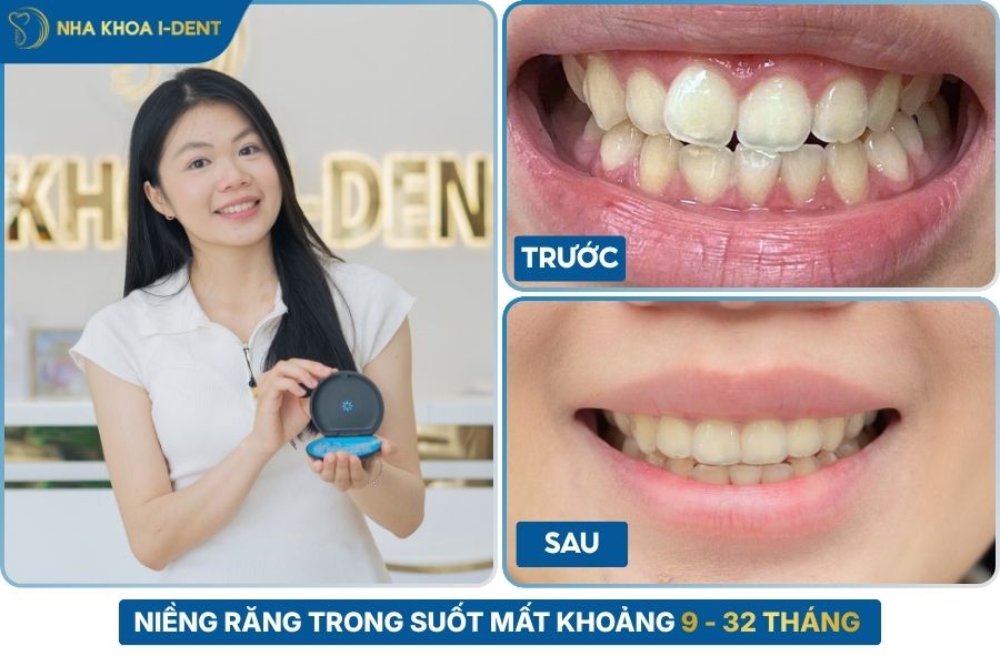 thời gian niềng răng trong suốt