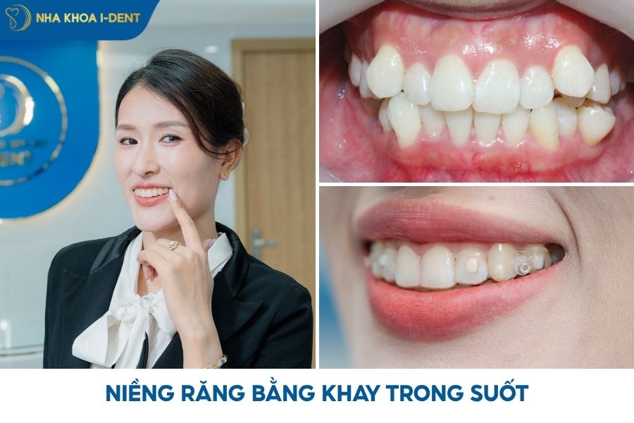 niềng răng trong suốt mất bao lâu