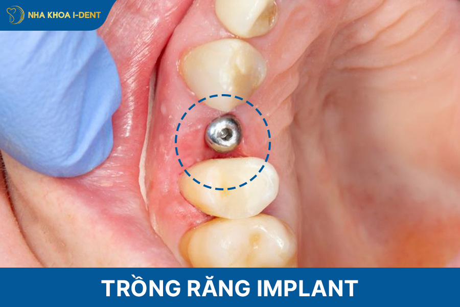 mất 1 răng hàm có sao không