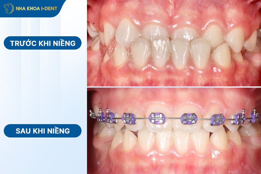 trước và sau khi niềng răng