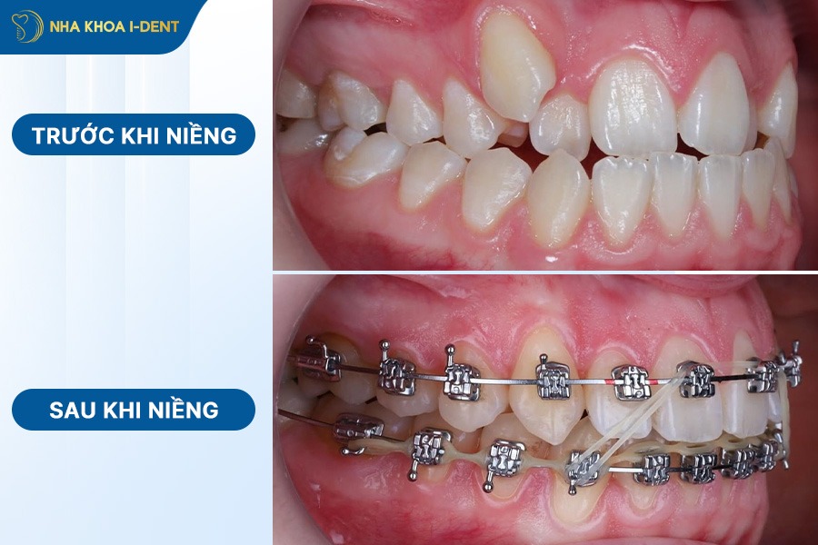 trước và sau niềng răng