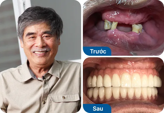 Chú Đỗ Tảng trồng răng Implant All-on-4 2 hàm.