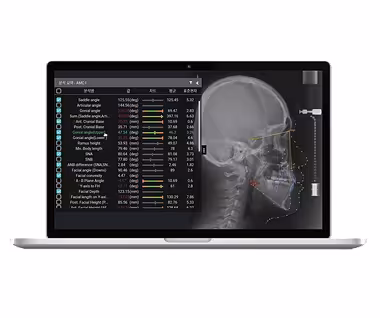 Nha khoa I-Dent ứng dụng công nghệ CBCT Guided Mini-screw trong việc cắm minivis trong chỉnh nha.