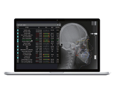 Nha khoa I-Dent ứng dụng công nghệ CBCT Guided Mini-screw trong việc cắm minivis trong chỉnh nha.