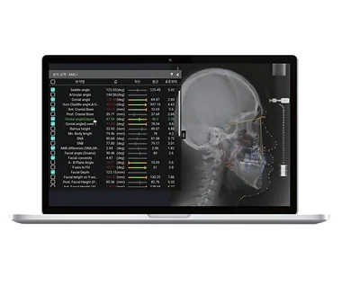 Nha khoa I-Dent ứng dụng công nghệ CBCT Guided Mini-screw trong việc cắm minivis trong chỉnh nha.