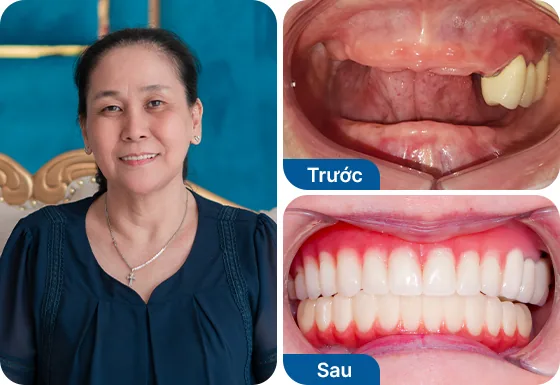 Cô Thanh Hương cấy implant toàn hàm All-on-4.