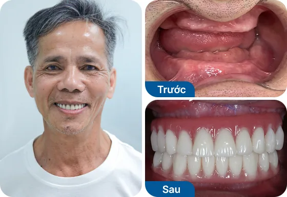 Chú Tâm Nguyễn trồng răng implant toàn hàm bằng phương pháp All-on-X.