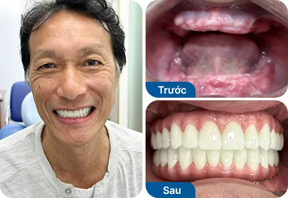 Chú Khánh Trí trồng răng implant 2 hàm bằng phương pháp All-on-6.