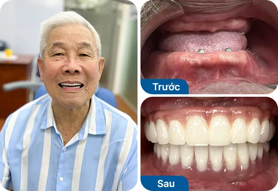 Chú Kim Được trồng răng implant 2 hàm bằng phương pháp All-on-4.