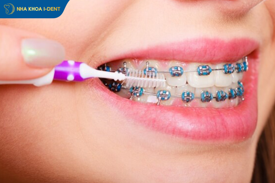 19 tuổi niềng răng được không