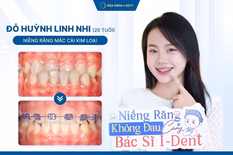 Hành Trình Niềng Răng Của Linh Nhi: Cải Thiện Khớp Cắn Ngược Sau 8 Tháng