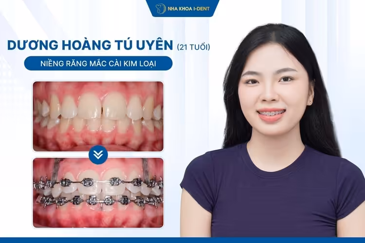Hành Trình Niềng Răng Của Tú Uyên: Từ “Răng Cánh Bướm” Đến Nụ Cười 10 Điểm