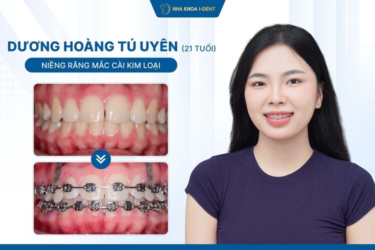 HÀNH TRÌNH NIỀNG RĂNG CỦA BẠN TÚ UYÊN: TỪ “RĂNG CÁNH BƯỚM” ĐẾN NỤ CƯỜI 10 ĐIỂM