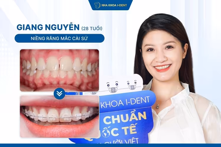 Hành Trình Niềng Răng Của Giang Nguyễn: Lựa Chọn Cần Thiết Cho Nụ Cười Chuẩn Mc