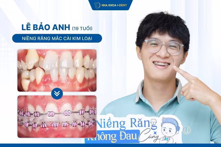 Hành Trình Niềng Răng Của Lê Bảo Anh: Từ Nỗi Sợ Cười Đến Nụ Cười Tự Tin