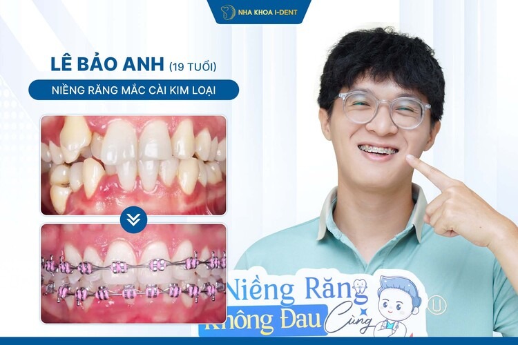 HÀNH TRÌNH NIỀNG RĂNG CỦA BẠN LÊ BẢO ANH: TỪ NỖI SỢ CƯỜI ĐẾN NỤ CƯỜI TỰ TIN