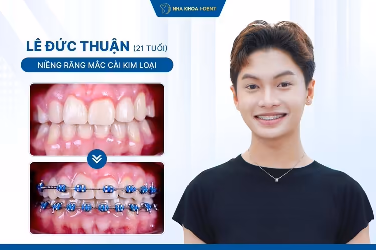 Hành Trình Niềng Răng Của Lê Đức Thuận: Khôi Phục Sự Tự Tin Khi Giao Tiếp