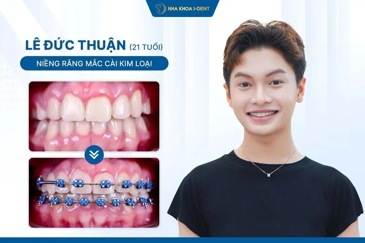 Hành Trình Niềng Răng Của Lê Đức Thuận: Khôi Phục Sự Tự Tin Khi Giao Tiếp