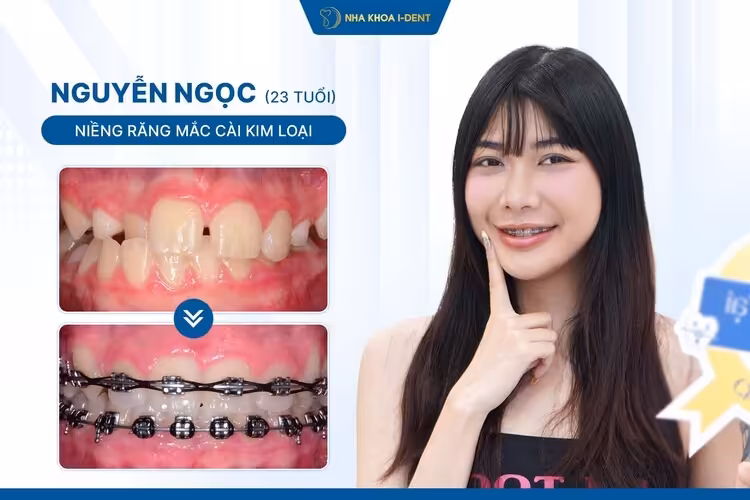 Hành Trình Niềng Răng Của Nguyễn Ngọc: Thay Đổi Nụ Cười, Thay Đổi Cuộc Sống