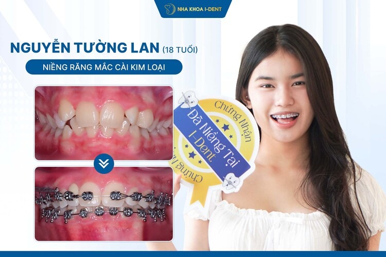 HÀNH TRÌNH NIỀNG RĂNG CỦA BẠN NGUYỄN TƯỜNG LAN: CHỈNH RĂNG THƯA, CÂN LẠI NHÂN TRUNG