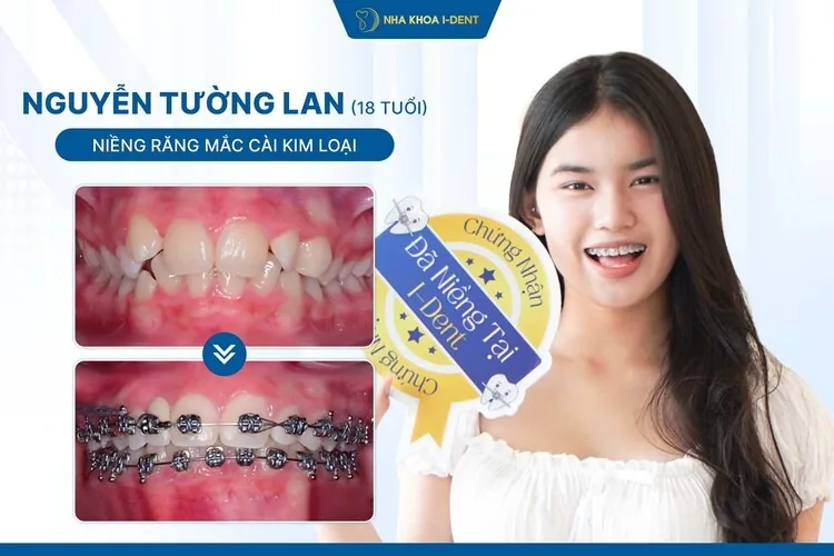Hành Trình Niềng Răng Của Tường Lan: Chỉnh Răng Thưa, Cân Lại Nhân Trung