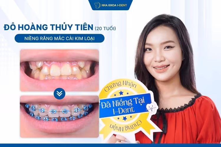 Hành Trình Niềng Răng Của Thủy Tiên: Từ Răng Lệch Lạc Đến Nụ Cười Cân Đối