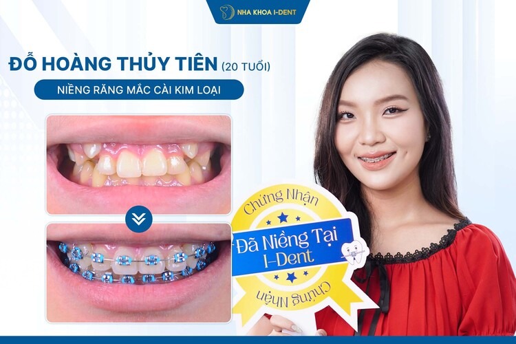 HÀNH TRÌNH NIỀNG RĂNG CỦA BẠN THỦY TIÊN: TỪ RĂNG LỆCH LẠC ĐẾN NỤ CƯỜI CÂN ĐỐI
