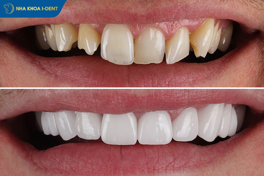 ảnh răng sứ