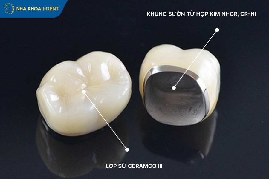 bọc răng sứ kim loại