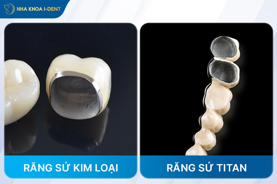 bọc răng sứ titan