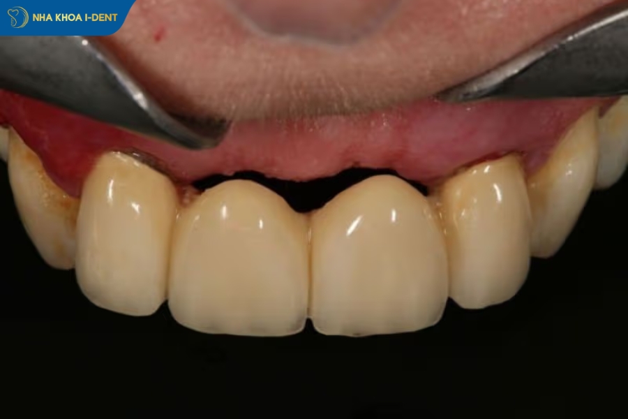 các loại trồng răng giả