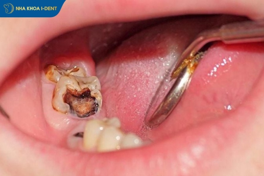 cách nhổ răng tại nhà