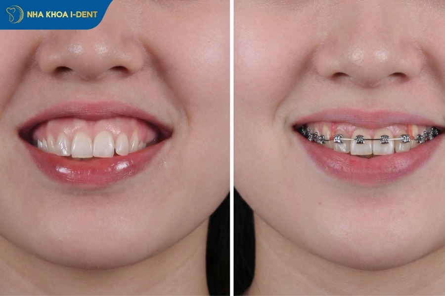 cắm vis niềng răng