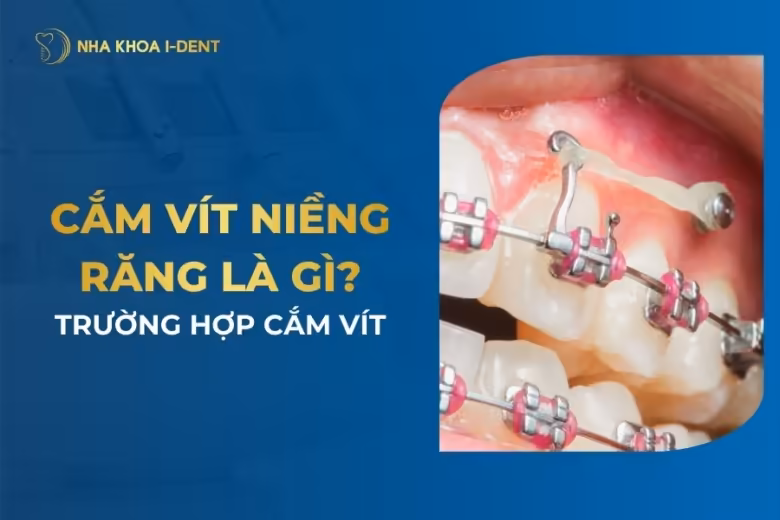cắm vít niềng răng