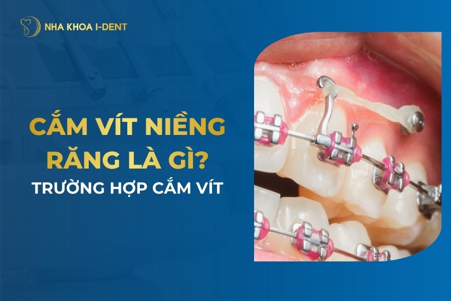 Cắm Vít Niềng Răng Là Gì? Trường Hợp Cắm Vít