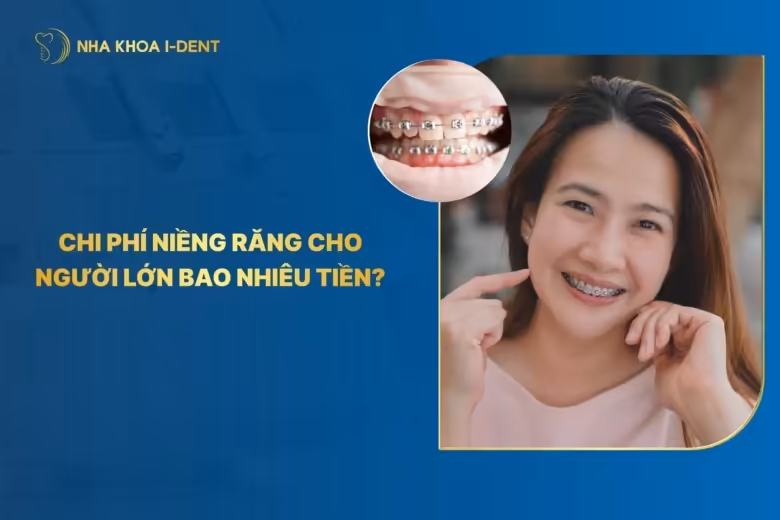 Chi phí niềng răng cho người lớn bao nhiêu tiền? Bảng giá