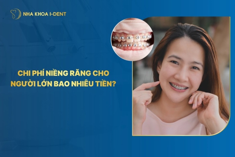 Chi phí niềng răng cho người lớn bao nhiêu tiền?