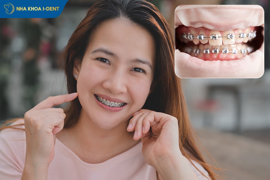 chi phí niềng răng cho người lớn