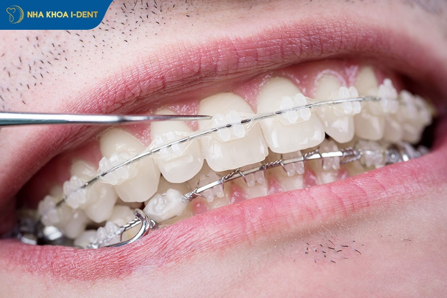 Chi phí niềng răng cho người lớn bằng mắc cài sứ