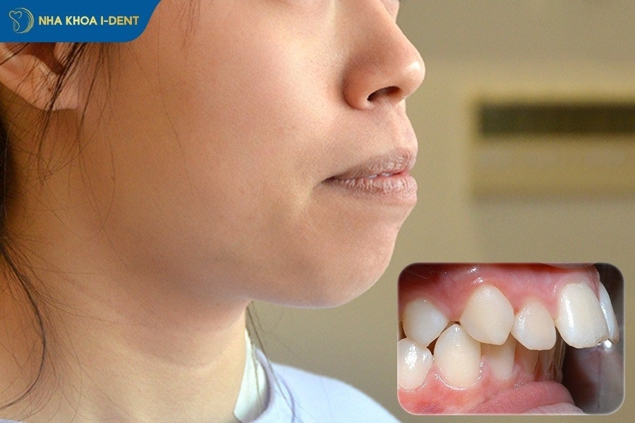 Răng hô là tình trạng răng cửa hàm trên nhô ra phía trước so với răng hàm dưới.