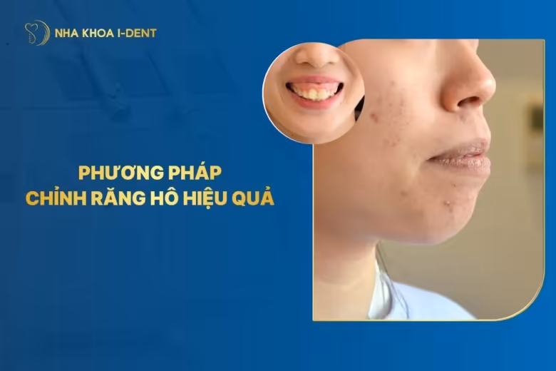 4 Phương Pháp Chỉnh Răng Hô Phổ Biến Hiện Nay