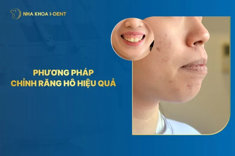 4 Phương Pháp Chỉnh Răng Hô Phổ Biến Hiện Nay