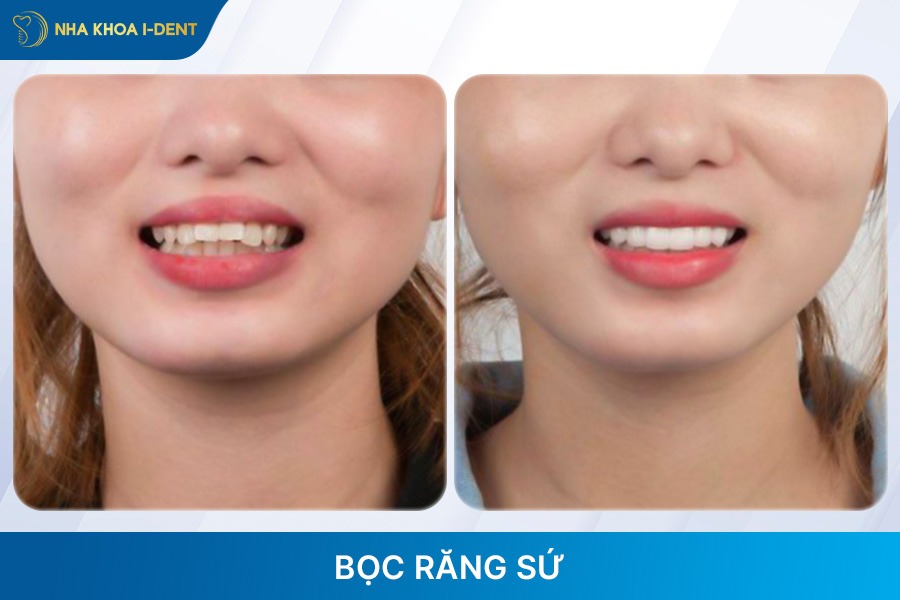 chỉnh răng hô bằng phương pháp bọc răng sứ