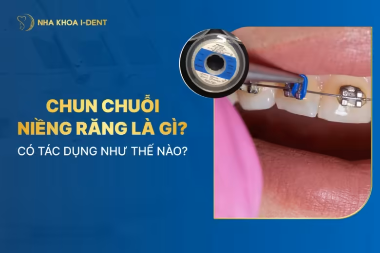 chun chuỗi niềng răng