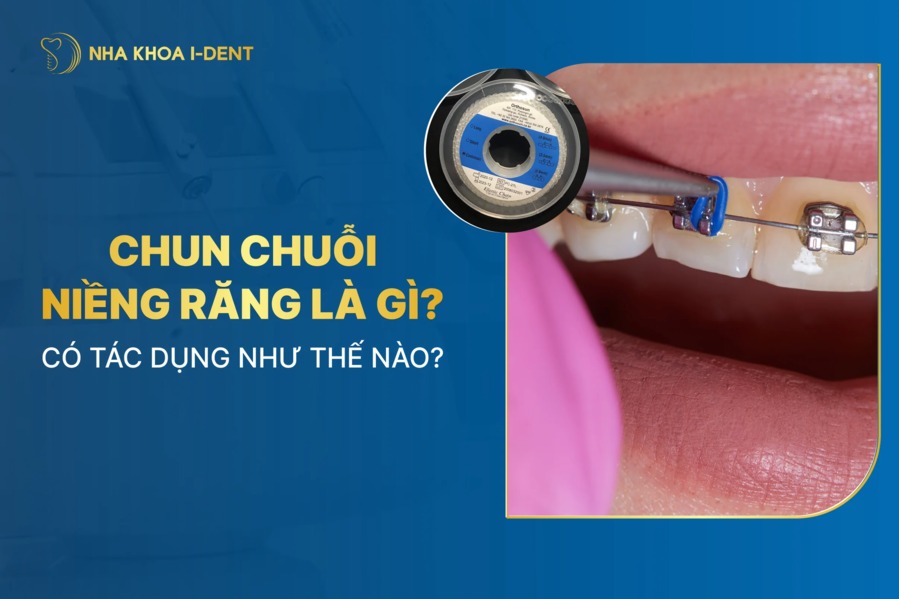 Chun chuỗi niềng răng là gì? Có tác dụng như thế nào?