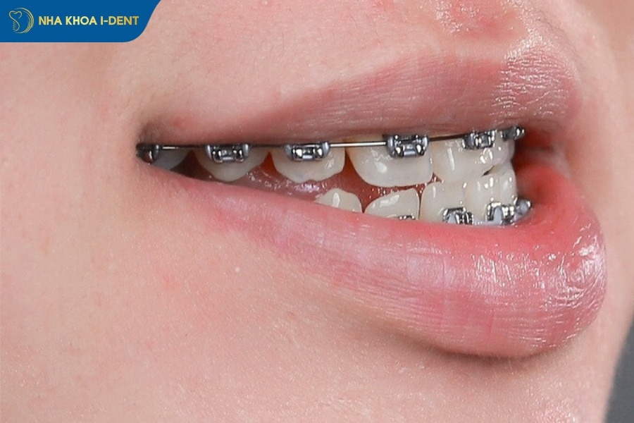 gắn vít khi niềng răng