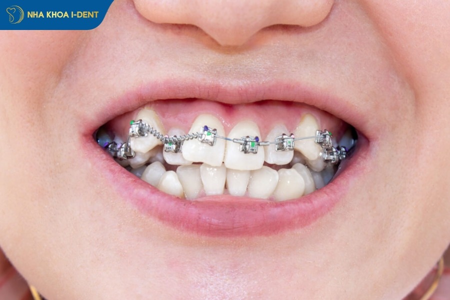 gắn vít niềng răng